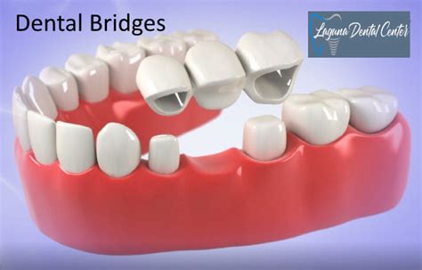 Dental Bridges: Types, Cost, Advantages, Procedure - Laguna Dental Center