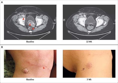 FDA Approves Pembrolizumab to Treat Merkel Cell Carcinoma - NCI