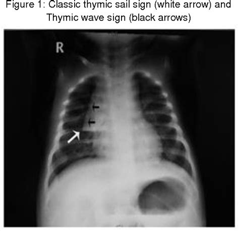 Figure 1 from Sail sign, significance in paediatrics and review of ...