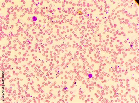 Iron deficiency Hypochromic microcytic anemia, red blood cells in a ...