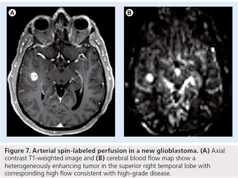 Role of MRI perfusion in improving the treatment of brain tumors