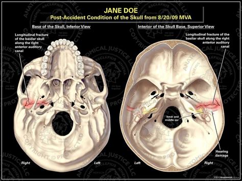 Basilar Skull Fracture