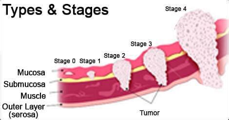 Stomach Cancer Types | Stages of Stomach Cancer