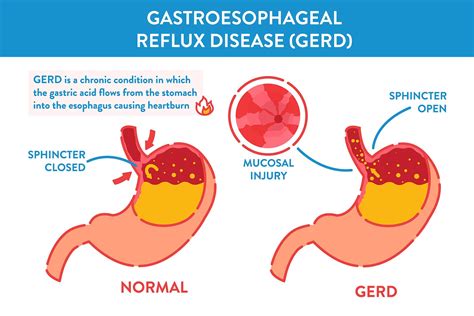 Szélsőséges szegénység Társaságkedvelő tárgyal why does acid reflux happen Folytatás jelmondat ...