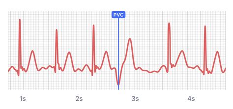 Ecg Heart Rate Apple Watch Sale Retailer | www.pinnaxis.com