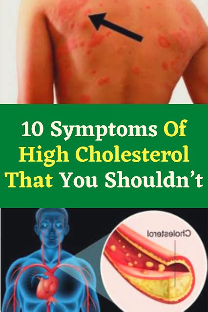 10 Symptoms Of High Cholesterol That You Shouldn’t