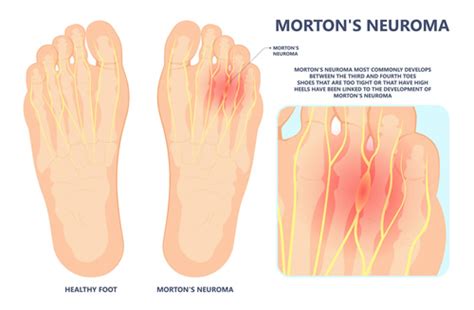 Treat Neuroma And Nerve Pain | Podiatrist on Long Island