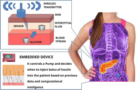 2: Artificial pancreas. | Download Scientific Diagram