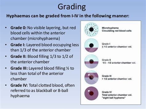 Hyphema