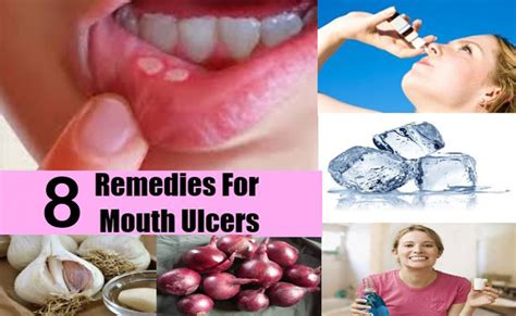 8 Home Remedies to Treat Mouth Ulcers Naturally | Best Herbal Health