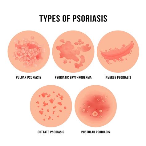 Psoriasis Types Chart