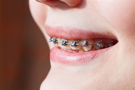 An Overview About Underbite Braces | oregoncareersinhealthcare.com