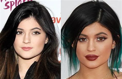 Kylie Jenner Plastic Surgery Before and After | Celebie