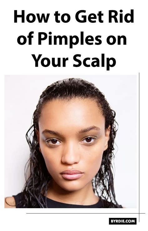 This Is Why You're Getting Pimples on Your Scalp Scalp Pimples Treatment, Pimples On Scalp ...