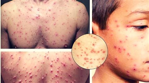 How to treat the chickenpox in children|How to diagnose,treatment and prevention of chicken pox ...