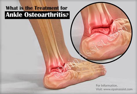 Ankle Osteoarthritis|Causes|Symptoms|Treatment|Recovery|Diagnosis