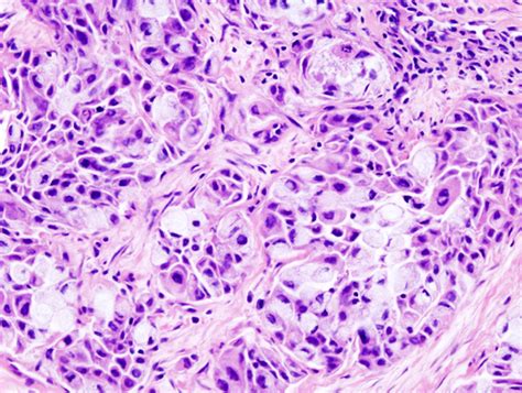 Mucoepidermoid carcinoma pathophysiology - wikidoc