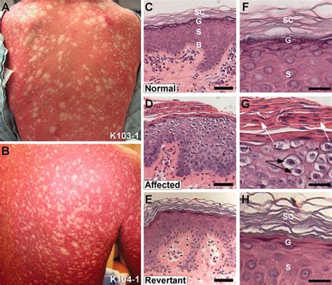 Mitotic Recombination in Patients with Ichthyosis Causes Reversion of Dominant Mutations in ...