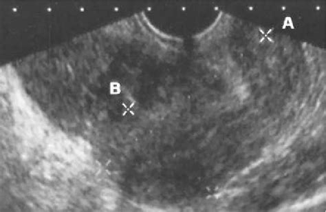 Ultrasound image of an early primary abdominal pregnancy in ...