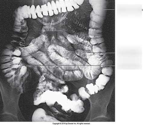 Figure 17-65. Enteroclysis procedure with barium visualized in colon. Diagram | Quizlet