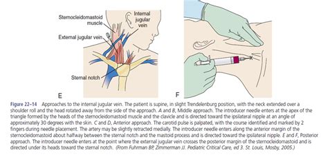 Internal Jugular Vein Catheterization « Review of Critical Care Medicine