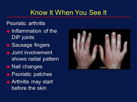 Psoriatic Arthritis: Symptoms, Diet & Treatment » How To Relief