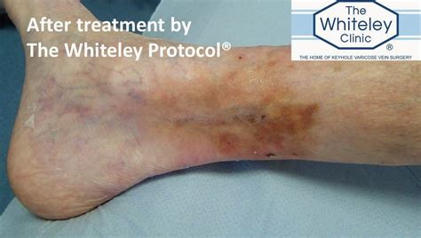 Venous Leg Ulcer cured by The Whiteley Protocol®