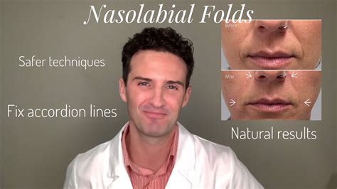 Nasolabial Fold Before And After