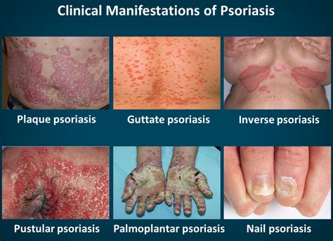 Diagnosis | PSORIASIS THRIVE