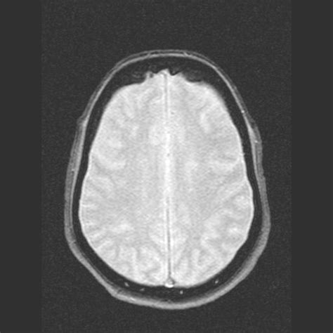 Hyperostosis frontalis interna | Image | Radiopaedia.org