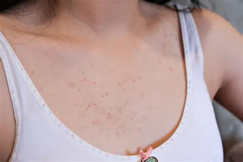 How to Get Rid of Chest Acne | LifeMD