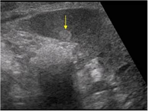 Abdomen and retroperitoneum | 1.4 Spleen : Case 1.4.2 Benign mass lesion of the spleen ...