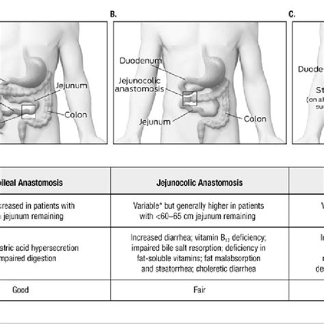 Types of intestinal resections: (A) jejunoileal anastomosis, (B ...