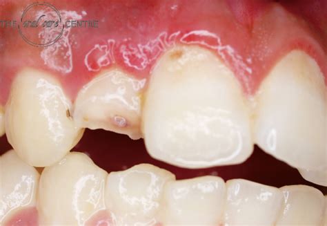 Traumatic Dental Injuries - Oralcare