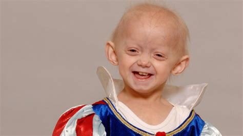 Progeria - Hutchinson Gilford Progeria Syndrome - Causes, Symptoms