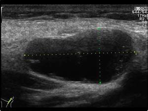 Head and Neck | 4.3 Salivary glands : Case 4.3.4 Warthin's tumors | Ultrasound Cases