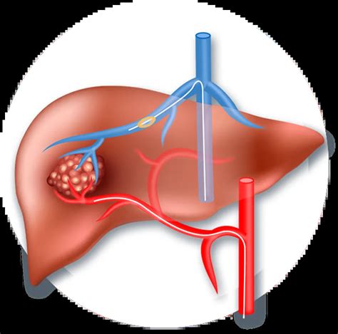 Transarterial Chemoembolization (TACE) for Liver Tumors - Dr. Harsh J Shah