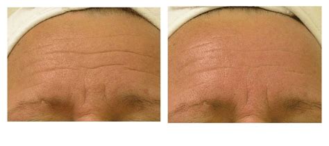 HydraFacial Advanced Facial Rejuvenation - Divine Medical & Cosmetic ...