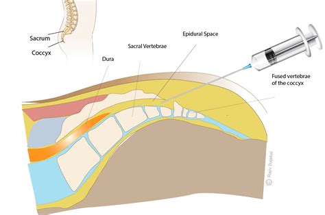 Caudal Epidural Injections – Rajiv Bajekal