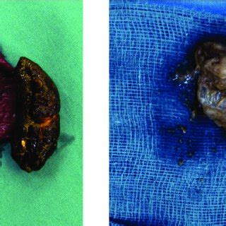 The case in Figure 1 above after small bowel resection (for possible... | Download Scientific ...