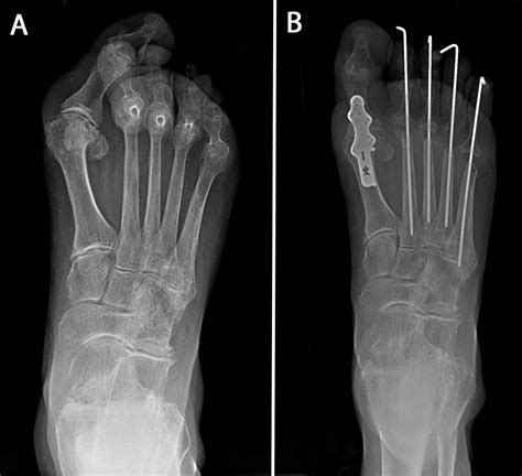 Rheumatoid Arthritis - OrthoInfo - AAOS