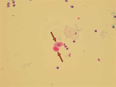 Epithelial cells in urine - what does it mean if you have epithelial cells in urine