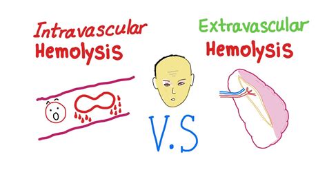 Intravascular Vs Extravascular Hemolytic Anemia; What's The ACTUAL ...