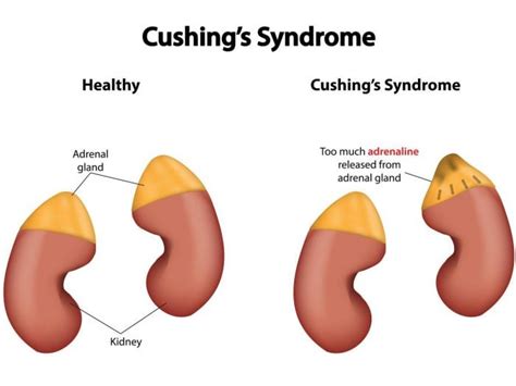 Top Natural Remedies For Cushing's Syndrome | Organic Facts