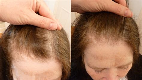 Female pattern baldness | International Hair Studio