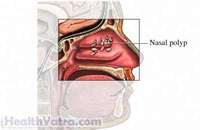 Nasal Polyp Definition, Causes, Symptoms, Complications and Cost ...