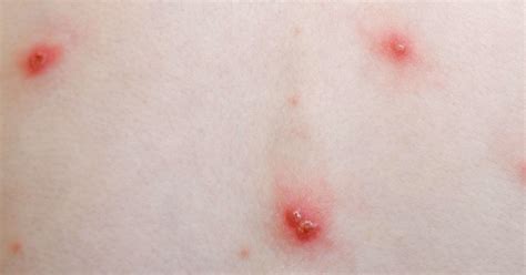 Chickenpox: Symptoms, treatment, stages, and causes