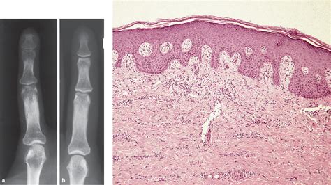 Figure 3 from Successful Treatment of Acrodermatitis Continua of Hallopeau with Sequential ...