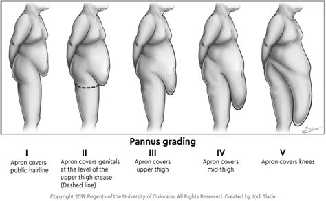 Excess skin problems among adolescents after bariatric surgery - Surgery for Obesity and Related ...