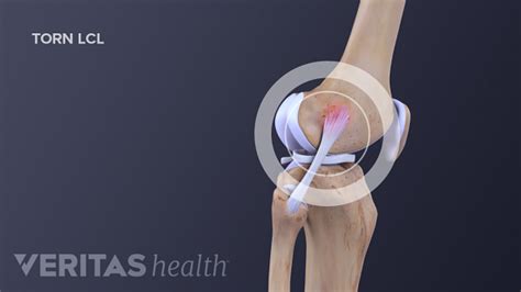 Lateral Collateral Ligament (LCL) Definition | Sports Injury-Related ...